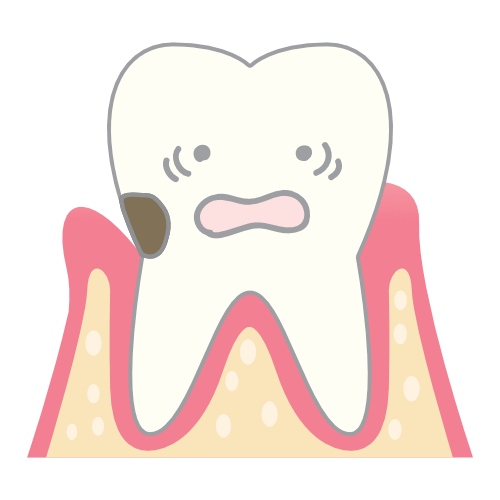 虫歯